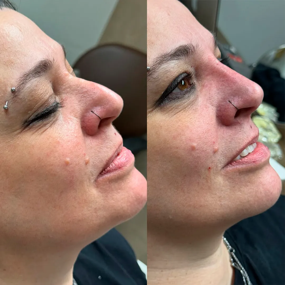 Antes e depois de harmonização orofacial