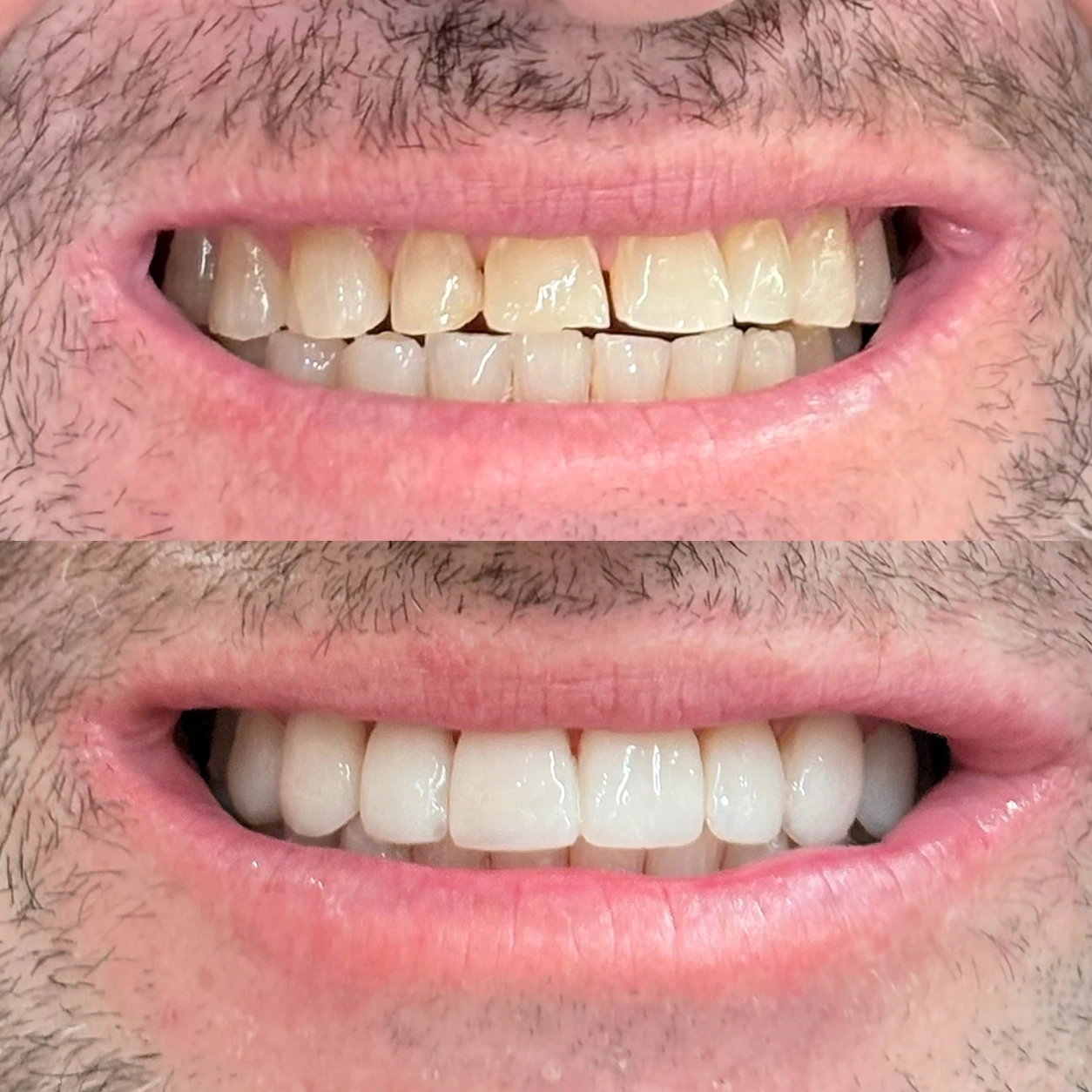 Antes e depois de lentes de contato dental